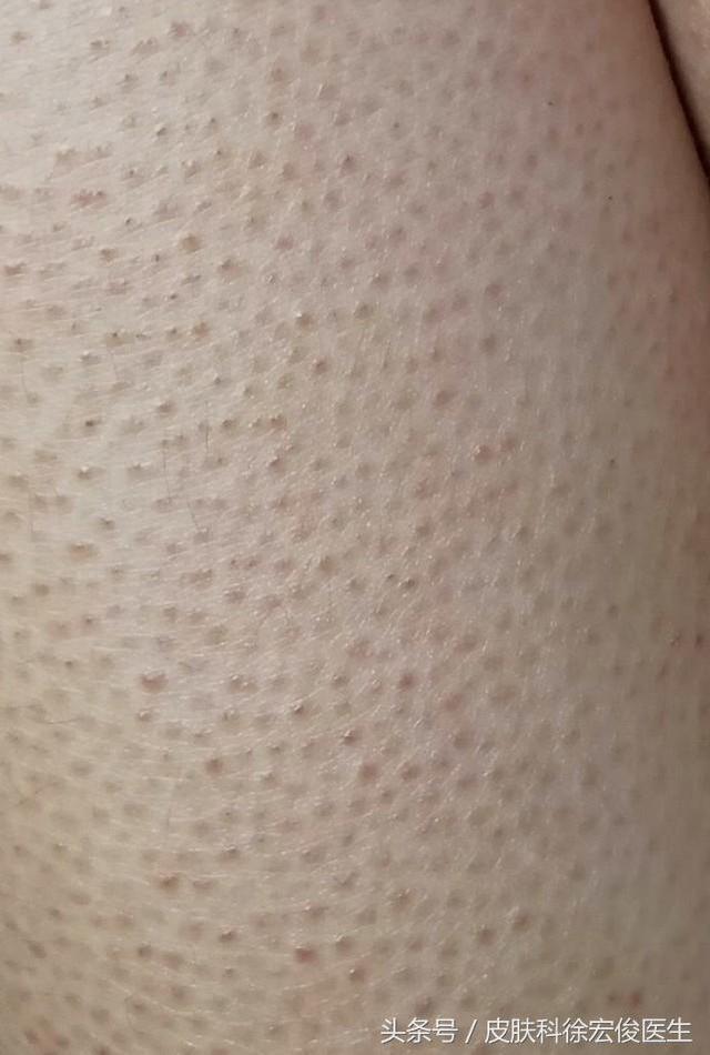 胳膊上像鸡皮疙瘩一样怎么治
