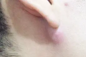 什么是皮脂腺囊肿，是如何引起的？视频封面