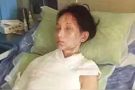 女子欲微博投诉被火锅店服务员开水浇头 获赔23万图片