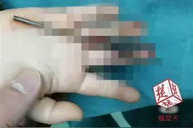 疼！武汉6岁顽童玩钢丝刺穿右手中指图片