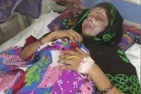 印度女子连生两女孩 女神节睡梦中遭包工头丈夫泼浓酸面目全非图片