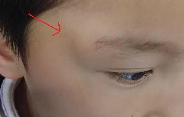 表皮样囊肿是怎么回事?如何治疗?