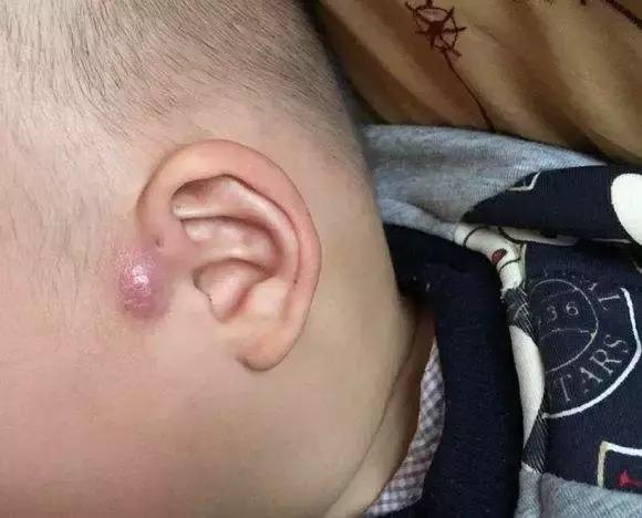 耳朵仓眼发炎怎么办