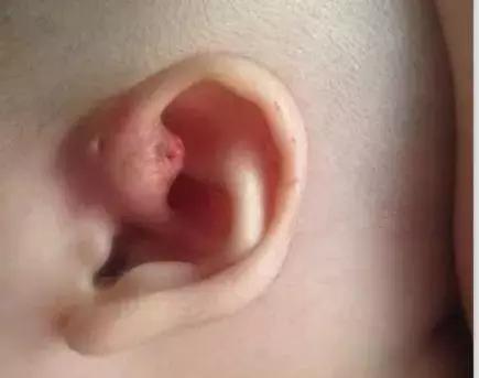 耳朵仓眼发炎怎么办