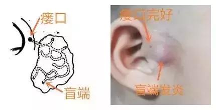 耳朵仓眼发炎怎么办