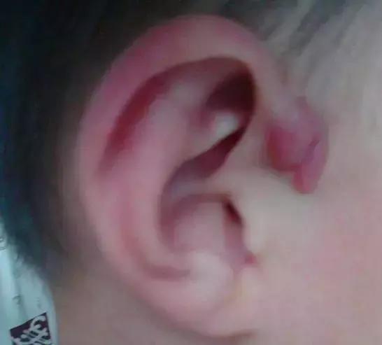 耳朵仓眼发炎怎么办