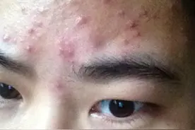 要消灭痘痘，得先知道痘痘是怎么来的图片