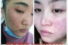 揭秘涵曦新品LATOJA排毒针效果怎么样 铅汞超标背后的内幕图片