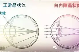 古稀老人白内障手术后重见光明图片