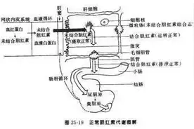 黄疸也要考虑到Gilbert综合征图片
