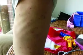被跳蚤咬伤感染支气管炎 跳蚤有5种危害图片