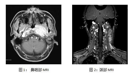 鼻咽部非角化性癌传染吗