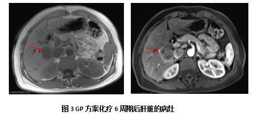 非角化型分化型癌