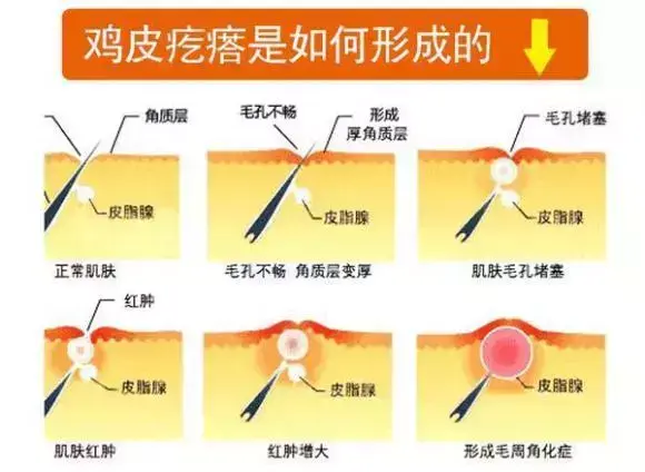 女生大腿根部鸡皮疙瘩