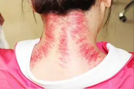 刮痧会不会伤气？体质虚弱的人适合刮痧吗？图片