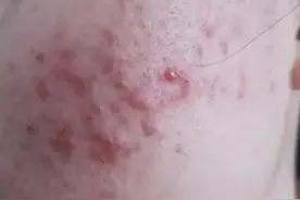 痘痘一长两年半，消不掉冒不出好心烦，怎么办？图片