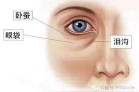 什么是「卧蚕」？它跟眼袋有什么区别？图片