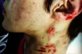 EXO吴世勋怎么伤的这么严重？大写的心疼！图片