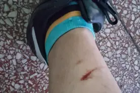 被狗咬伤：到底应该怎么进行狂犬疫苗注射图片