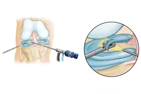 治疗骨性关节炎的方法是什么图片
