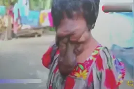 花季少女得怪病 整张脸完全扭曲看不出原来面貌视频封面