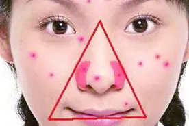 超级细菌！浙江一男生手贱挤了个痘子，不幸感染超级细菌，生命垂危图片