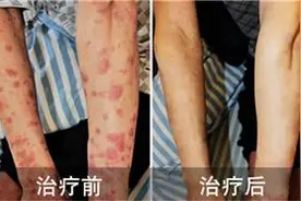 银屑病让她苦苦挣扎12年 治愈后看到全新人生轨迹图片