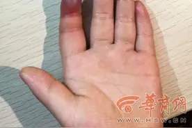 家长注意！西安4岁女童皮筋套手指睡着 手指缺血性坏死差点截肢图片