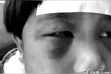 女童眼圈青肿 奶奶打的图片