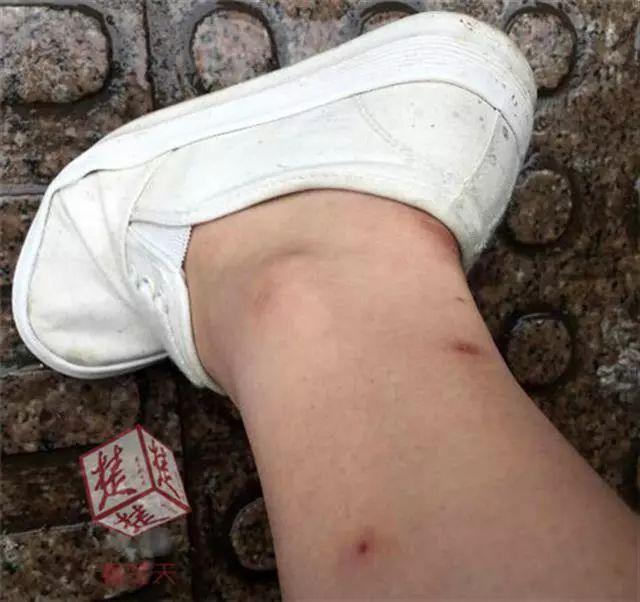 提醒|最近在家或外出都要小心它!一周内已有多人中招进医院……