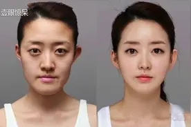 整容前后惊人对比