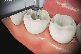 动画模拟根管治疗（杀神经）过程，牙疼的看过来！