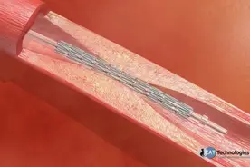 医学3D动画演示：冠状动脉支架植入术全过程视频封面