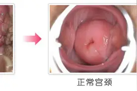 有症状的宫颈囊肿如果不治疗有哪些危害？图片