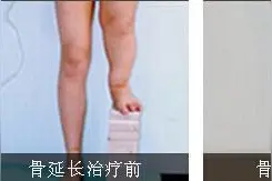 骨延长手术后应该如何护理图片
