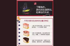 一图了解烧伤、烫伤的处理原则图片