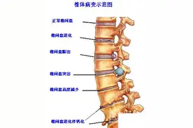 腰椎间盘突出的症状以及治疗方法图片