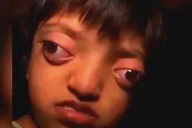 印度女孩患有罕见疾病 眼球凸出像青蛙一样视频封面