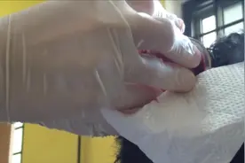 【猎奇】中东人拔血罐，拔出血块形似果冻