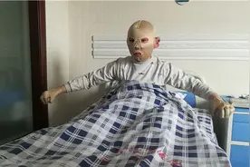 周口11岁男孩意外烧伤毁容 姐姐:请把我的脸换给弟弟吧图片