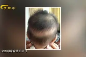 宝宝后脑勺头发稀少是因为缺钙？专家这样一说瞬间恍然大悟视频封面