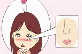 问答｜怎么才能告别“草莓鼻”变回小仙女？图片