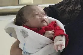 婴儿出生身上发紫，原来是大动脉长反了，不及时治疗活不过满月图片