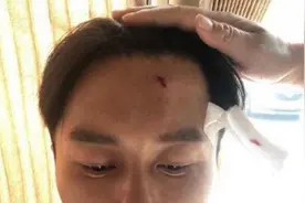 李晨录影额头受伤缝9针 网红夫妻整成范冰冰＋李晨图片