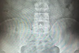不慎摔跤腰痛一周，元凶竟是小小结石图片