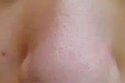 用手挤黑头的危害图片