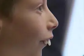 外国一个男孩天生兔牙，被小伙伴歧视，经过医生努力效果明显视频封面