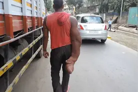 印度男子患罕见巨手症  认定是魔鬼 被亲生父母赶出家门图片