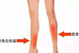 小腿前面疼痛还能继续跑步吗？图片