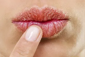 夏季吃芒果为什么会引发嘴唇过敏图片